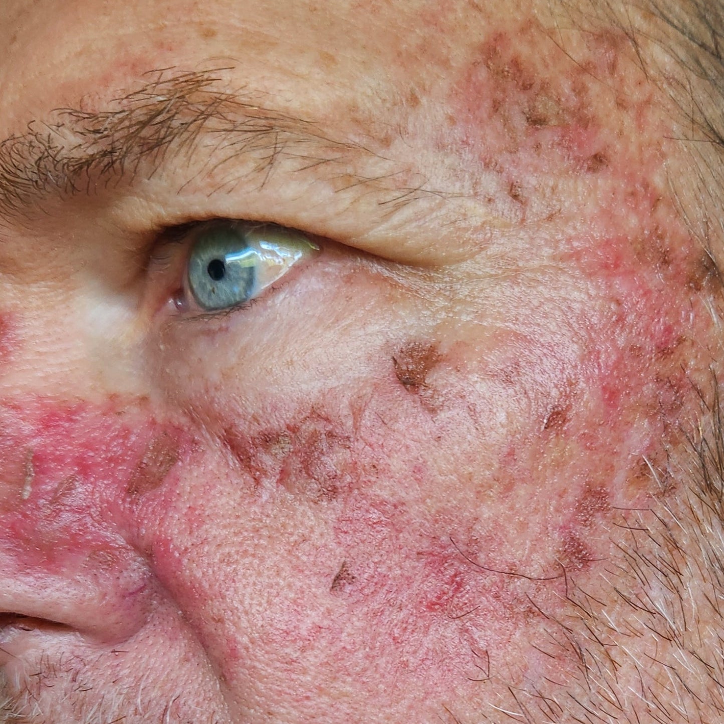Close-up of a man's face with visible skin conditions