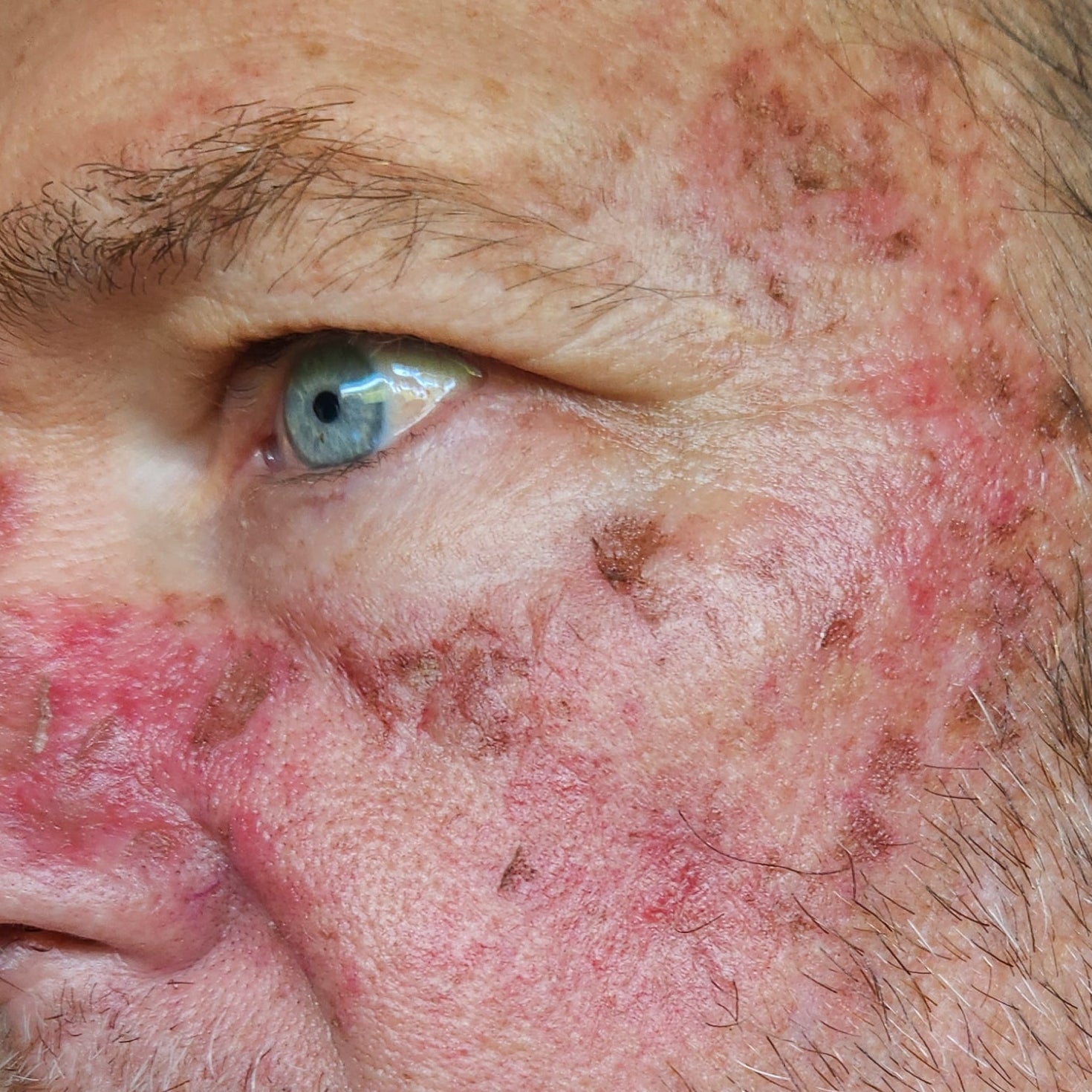Close-up of a man's face with visible skin conditions